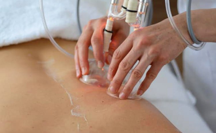 Massage therapist applying the cups of the Biorhythmic Drainer to a client's back during a lymphatic drainage massage