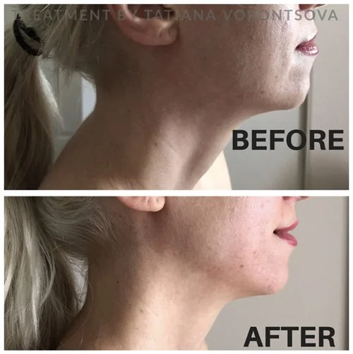 NeoLifting Facial Before & After treatment