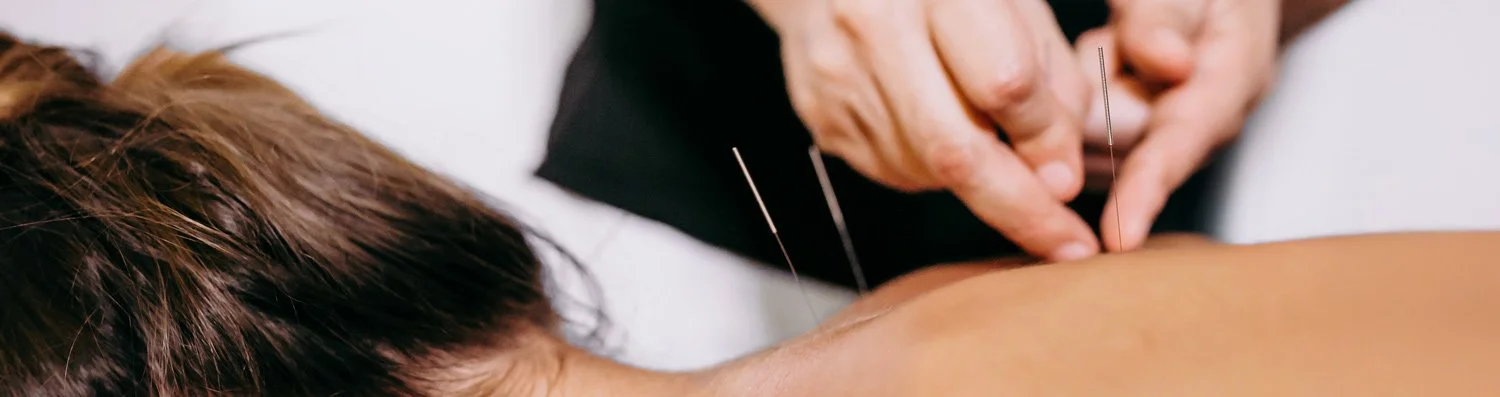 Acupuncturist placing needles into female patient’s upper back during a dry needling session