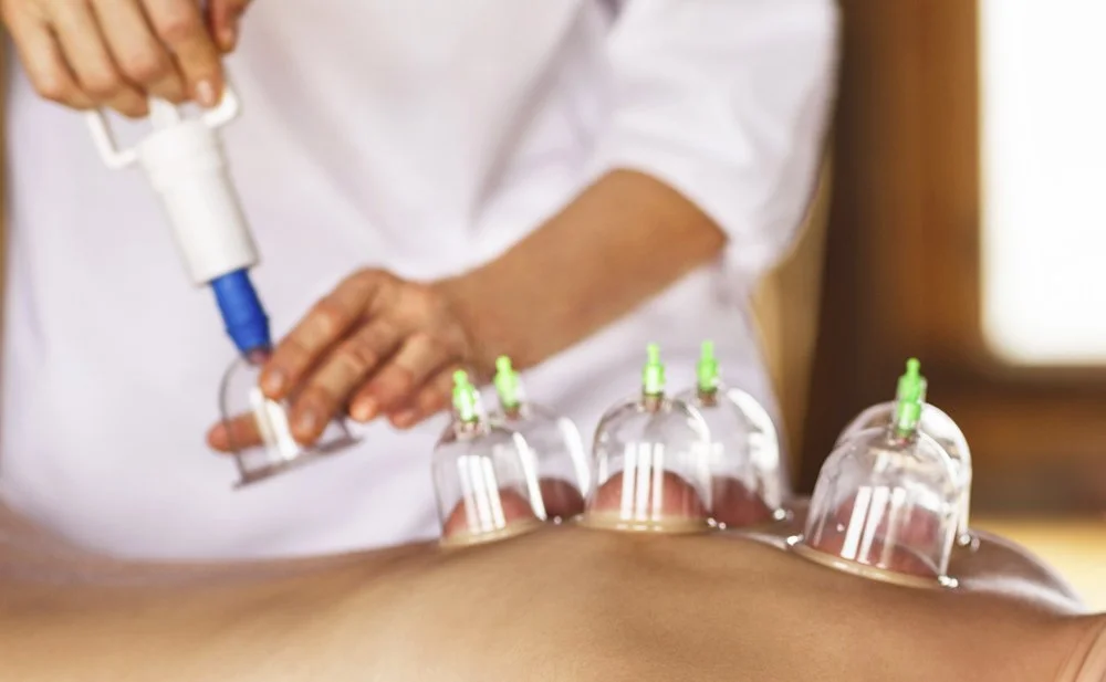 Acupuncturist performing cupping therapy and applying cups along the patient’s back