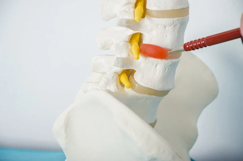 slipped disc and chiropractic.jpg