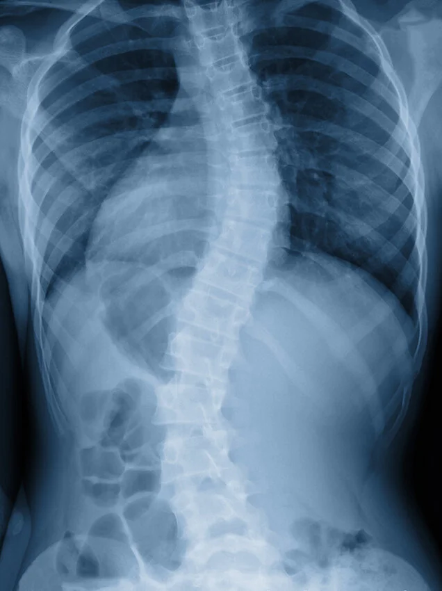 Scoliosis and chiropractic.jpg
