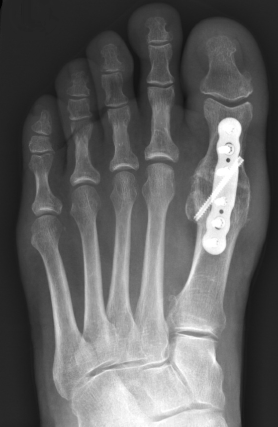 Big Toe Fusion — Chicago Foot And Ankle Orthopaedic Surgeons