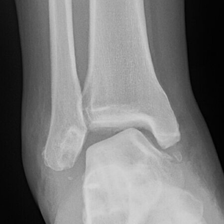 Ankle Instability — Chicago Foot & Ankle Orthopaedic Surgeons