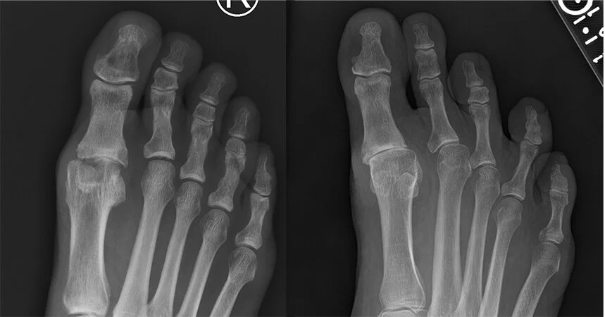 Hallux Rigidus Überlanges Zehenstrahl – QKZIZV