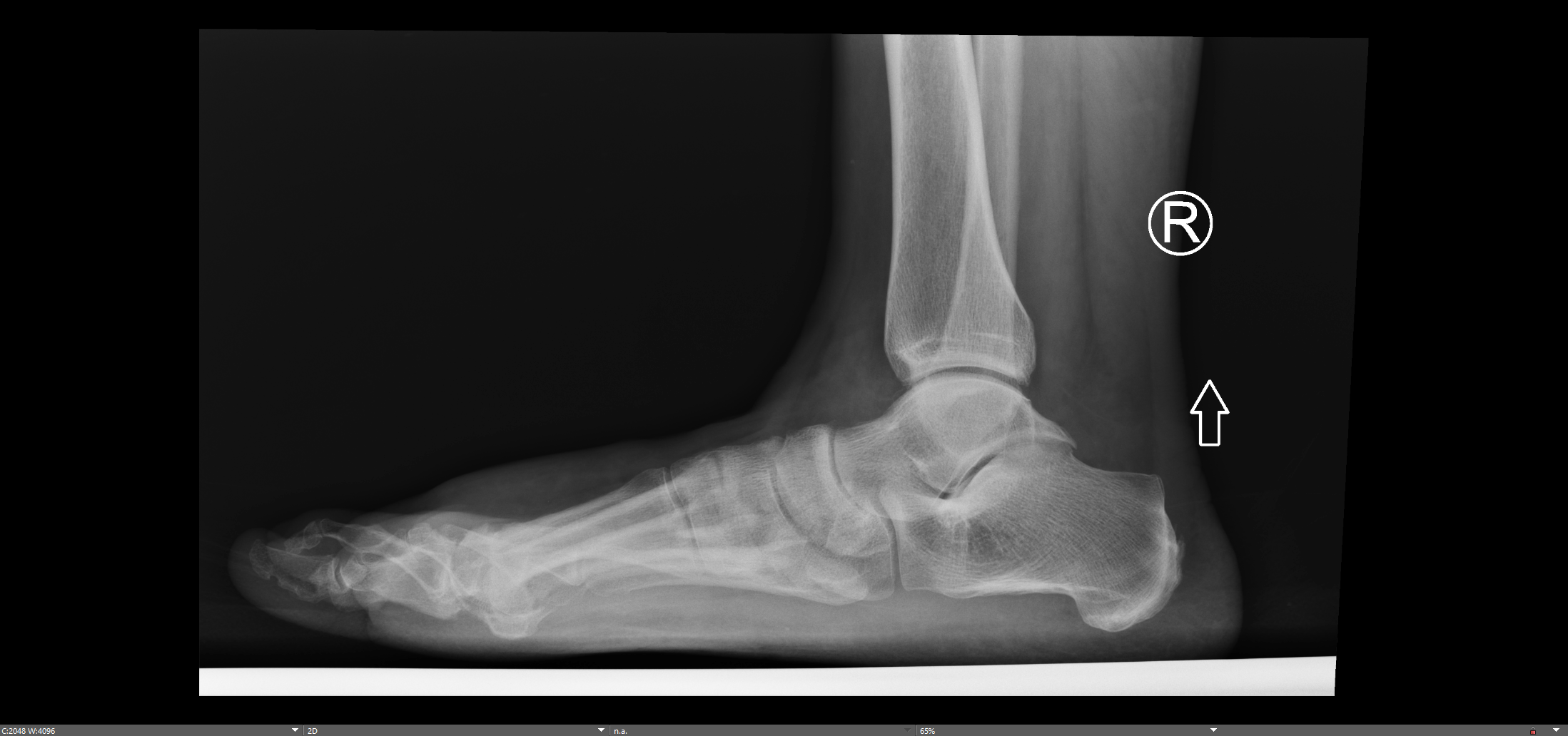 1st Mtp Revision Fusion From Failed Cartiva — Chicago Foot And Ankle Orthopaedic Surgeons
