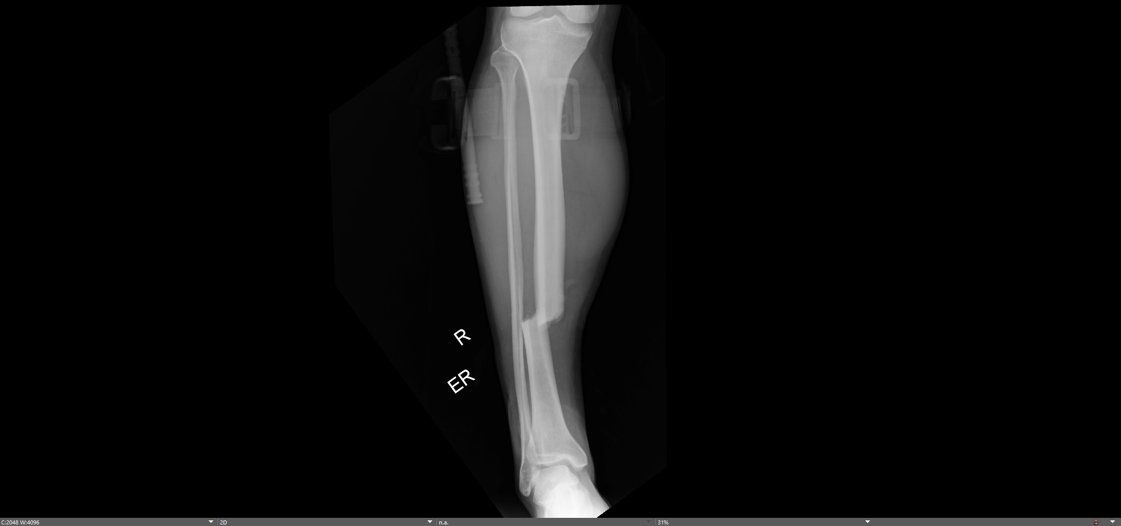 Tibia Shaft Fracture — Chicago Foot And Ankle Orthopaedic Surgeons