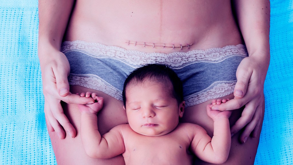 SheKnows—Outrageous C-Section Myths, Busted 