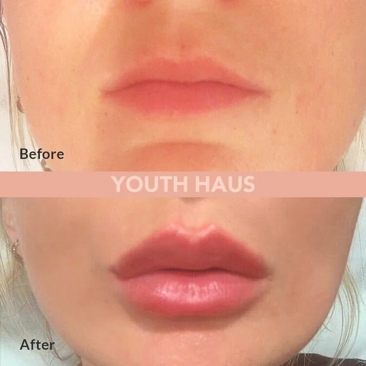 lip injections near me book online Tam Bain