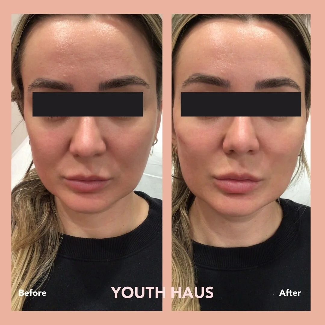 Juvederm Cheeks Before And After Photos