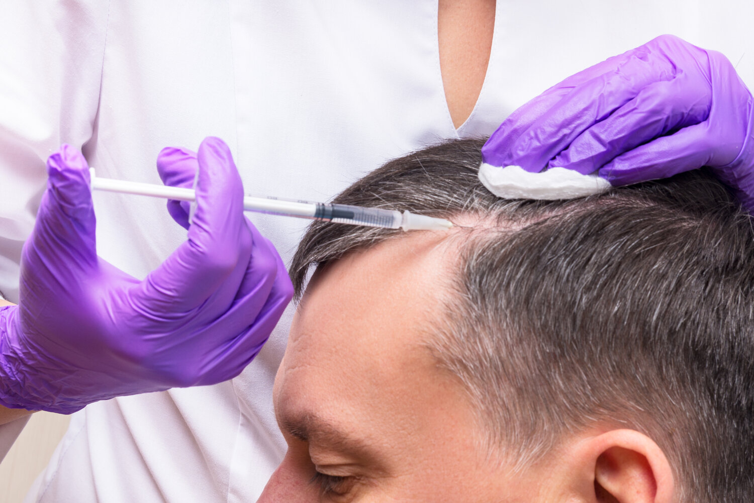 Hair Restoration Microneedling with PRP — Youth Haus