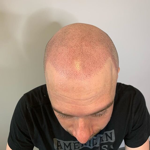 Can&rsquo;t wait to finish this client when all of this is over! 
Scalp Envy SMP Studios
Whitby, On
905-903-6168
@bodyblisswhitby 
www.scalpenvy.ca
scalpenvysmp@gmail.com 
#scalpmicropigmentation #smp #permanent #tattoo #ink #hair #scalptattoo #men #