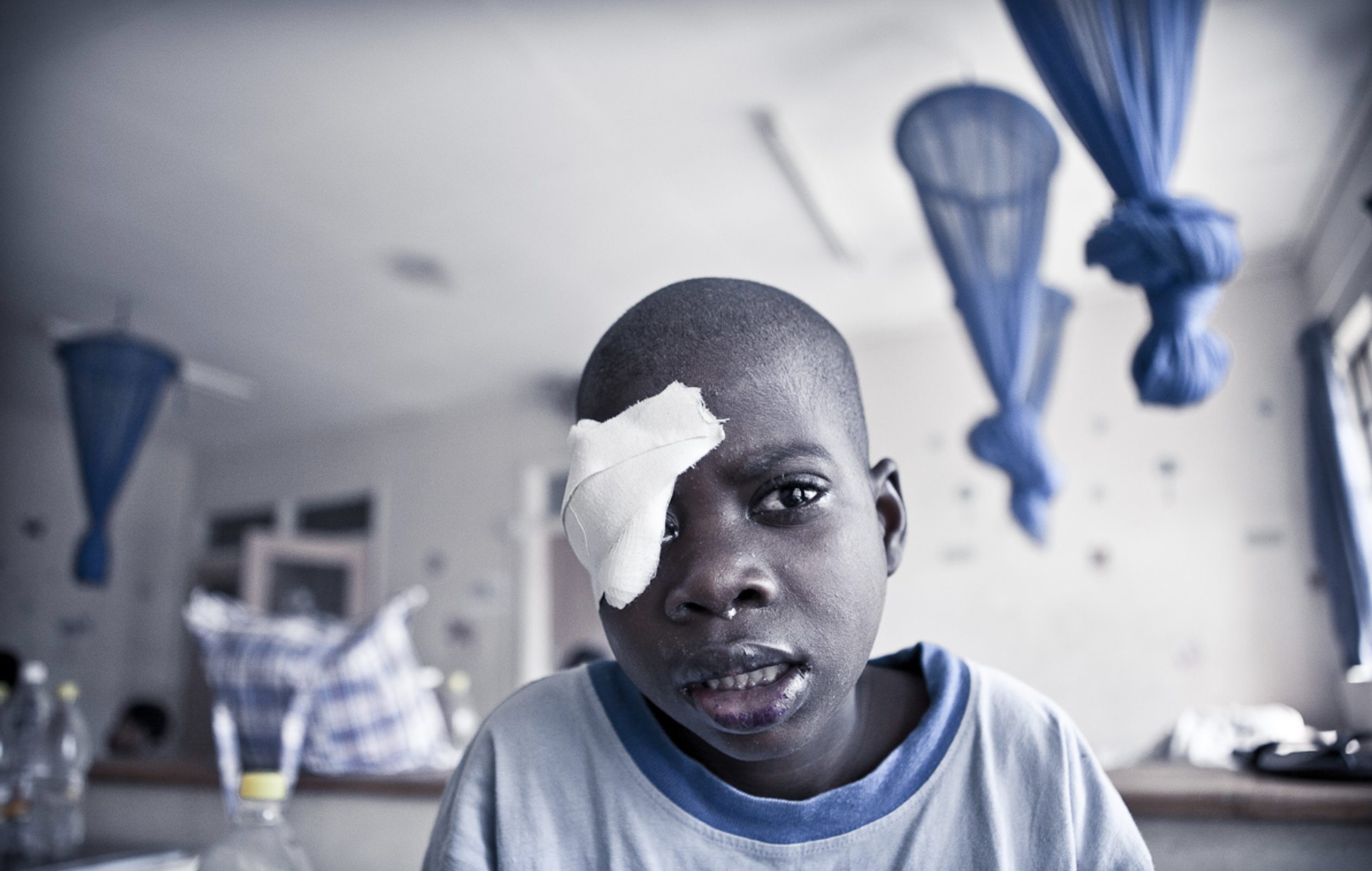  Child cataract patient in the children's ward after his cataract surgery 