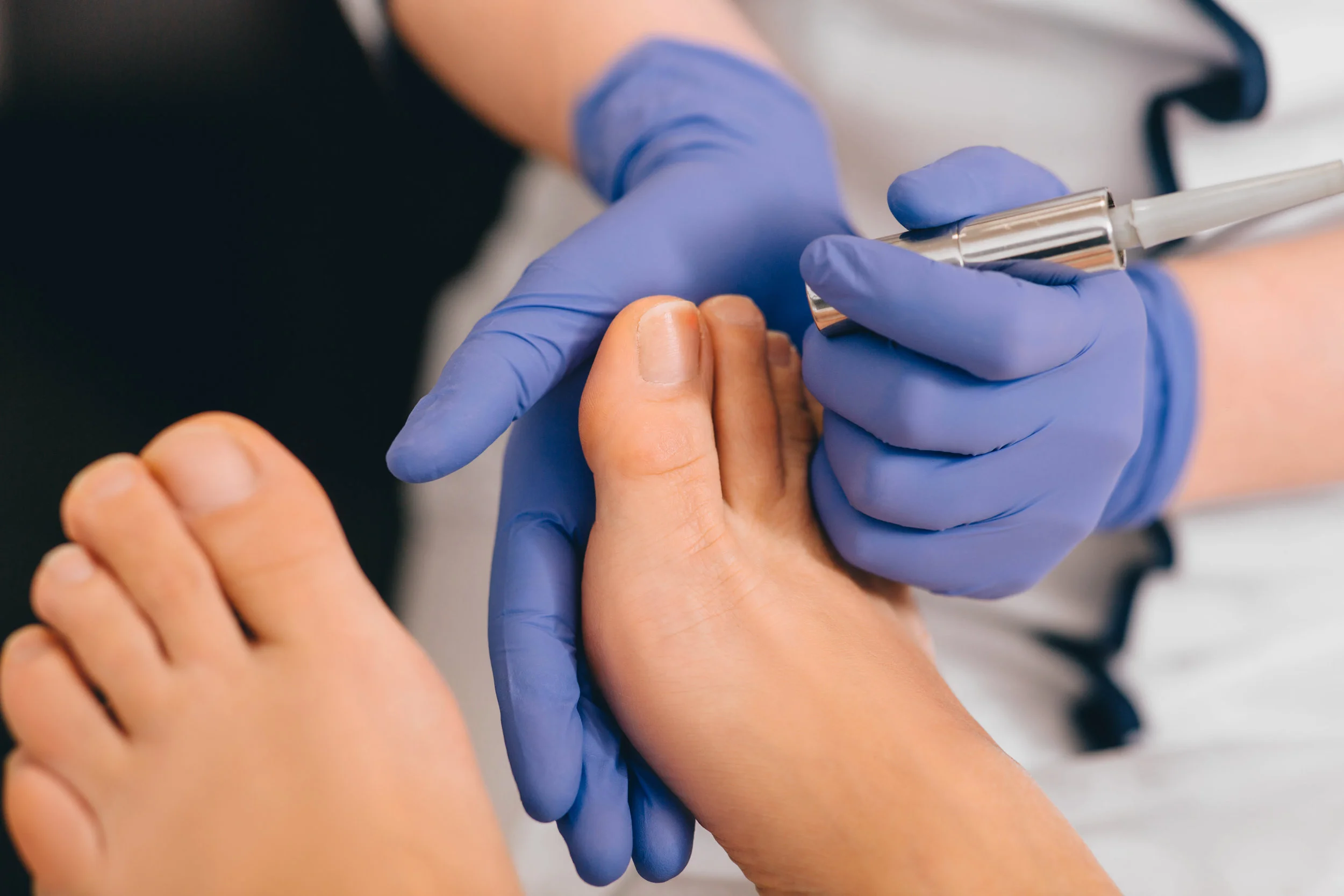 New fungal nail treatment available NOW!