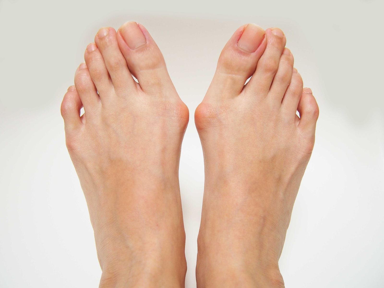 Worried about bunions?
