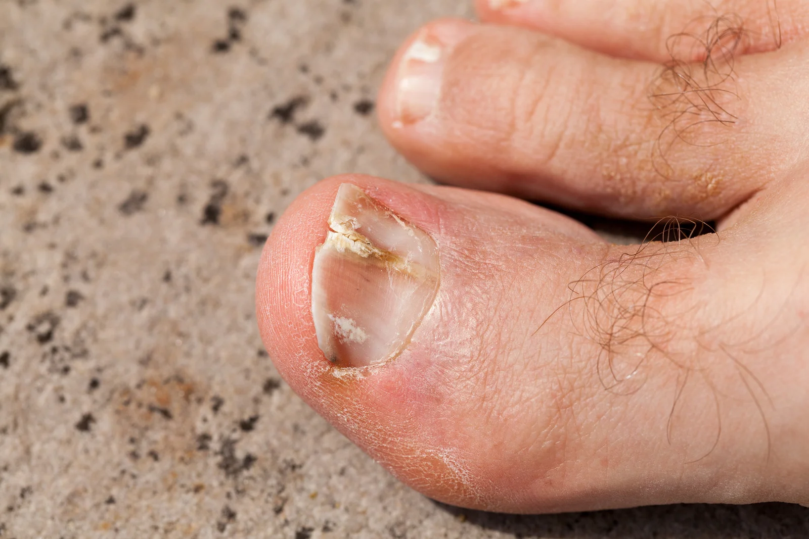 Toenail terrors: simple fixes for your toenail problems
