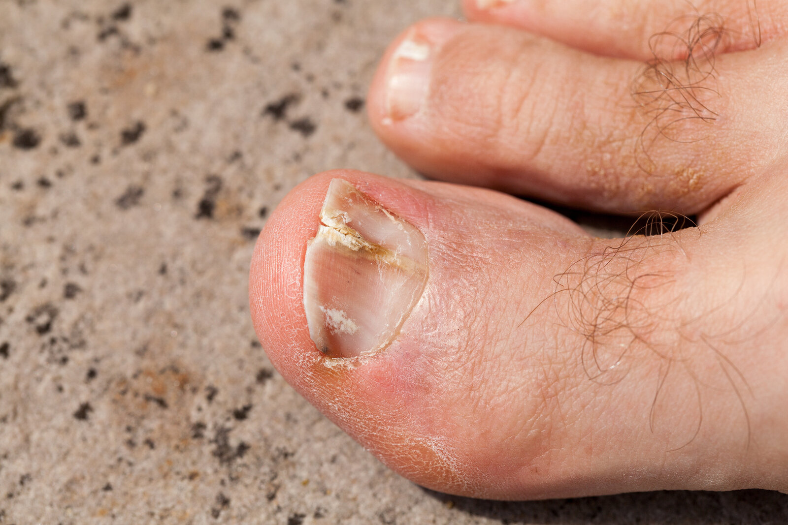 Fungal Nail Infections | Ausmed