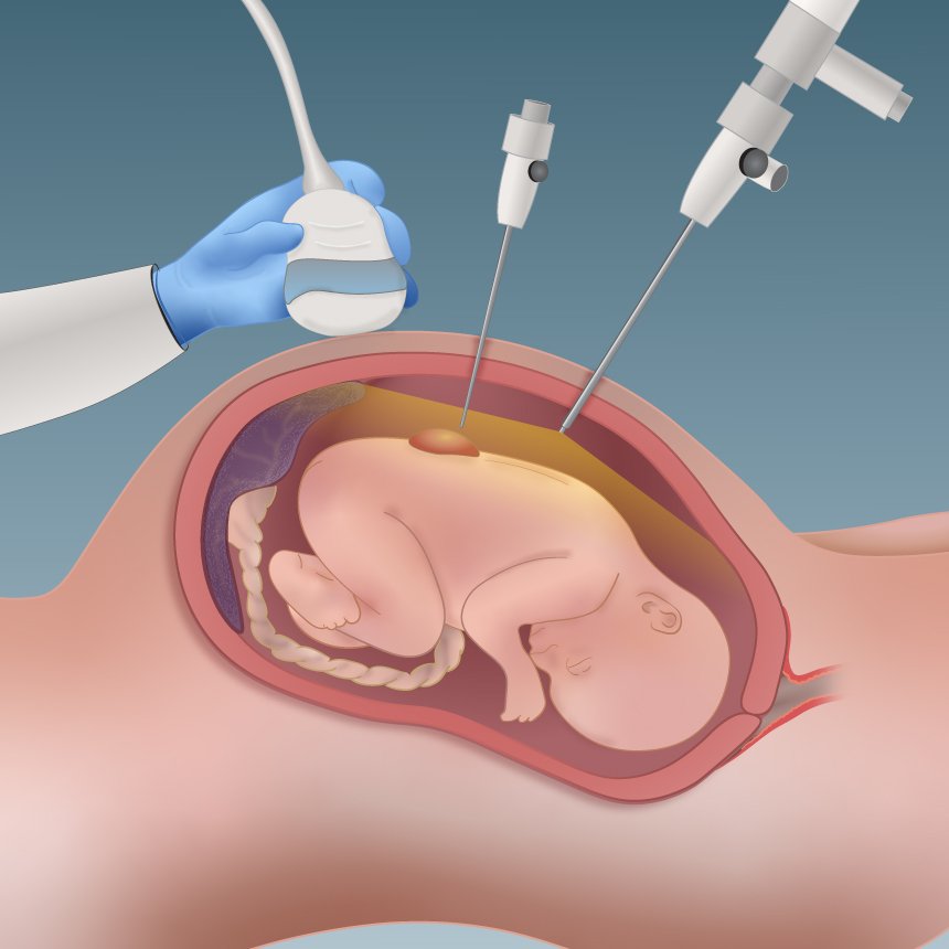 Foetal-surgery_Graphit2.jpg