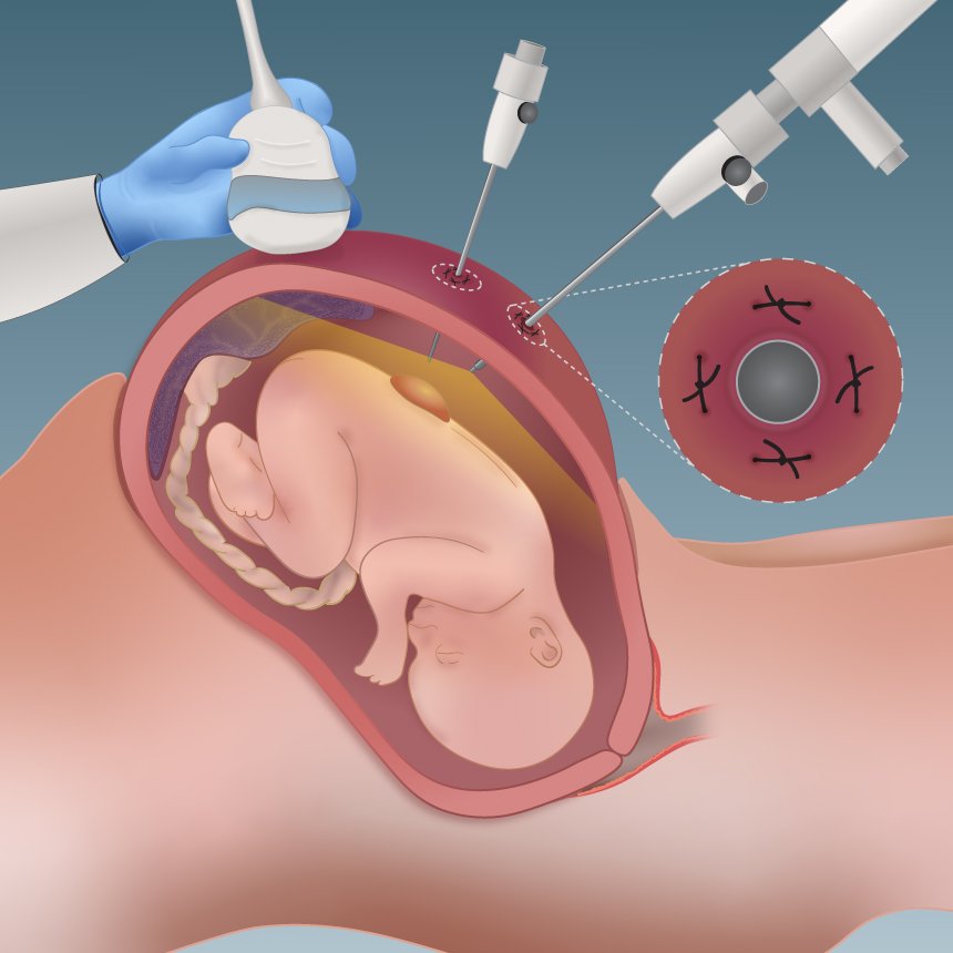 Foetal-surgery_Graphit3.jpg
