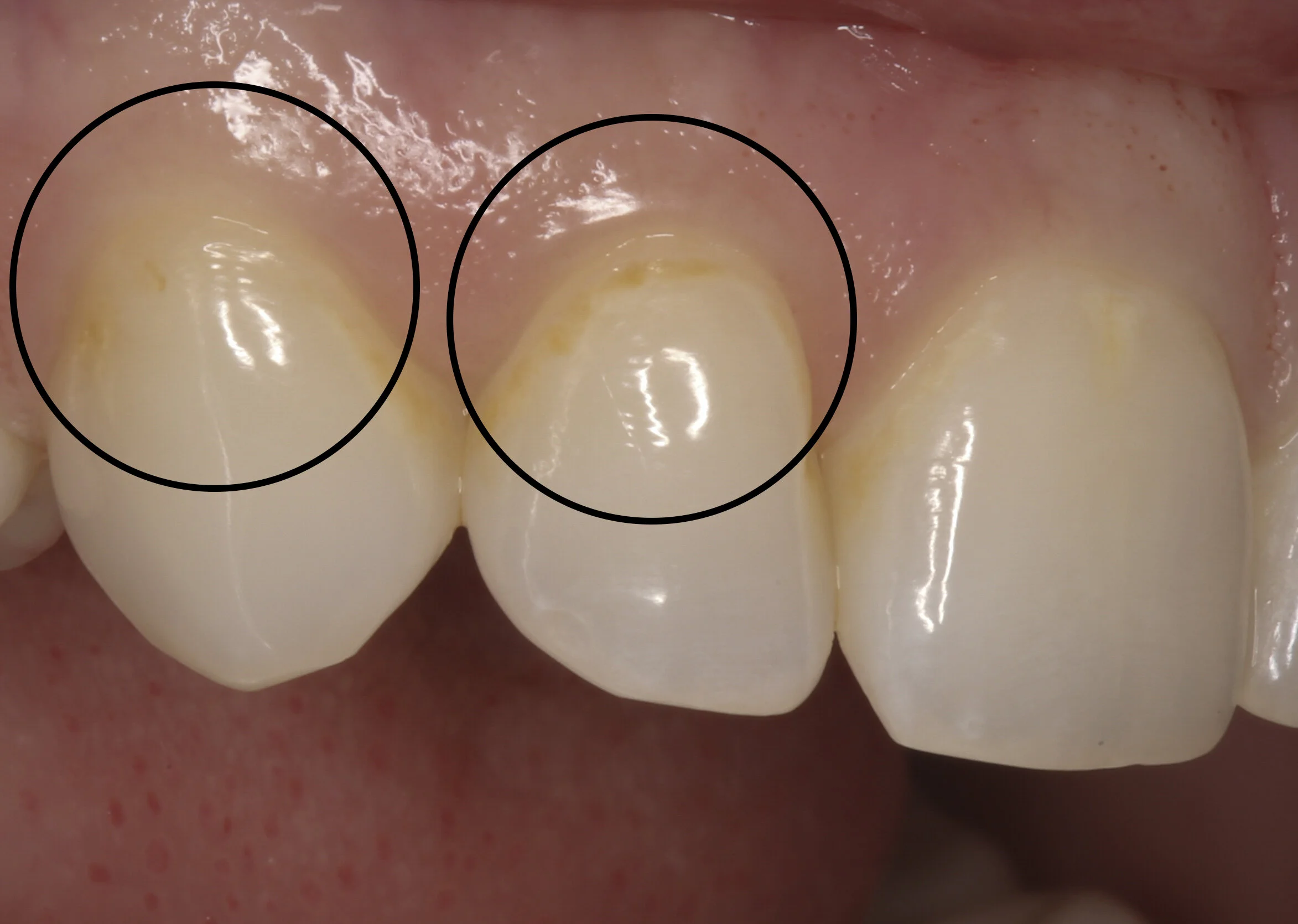 Composite Fillings — Predmore Dental