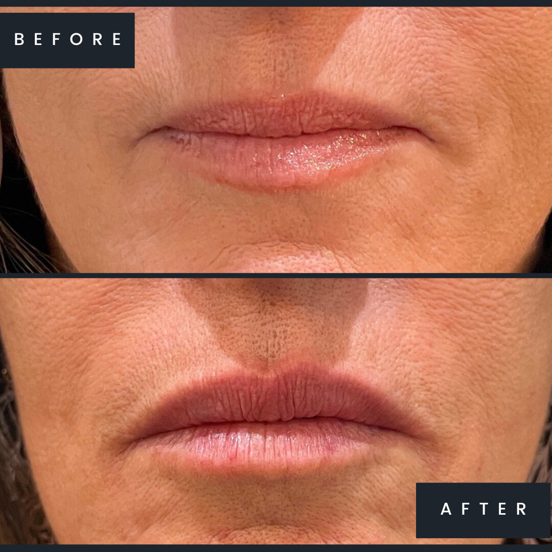 Nicole added a little filler to improve the volume and symmetry of this client's lips💉💋 #LipFillerBeforeAndAfter

Book an injectable consultation today:
🔗 Link in bio 
📲 (718) 945-1100
💌 nicole@nicolefronterabeauty.com

#nicolefronterabeauty #qu