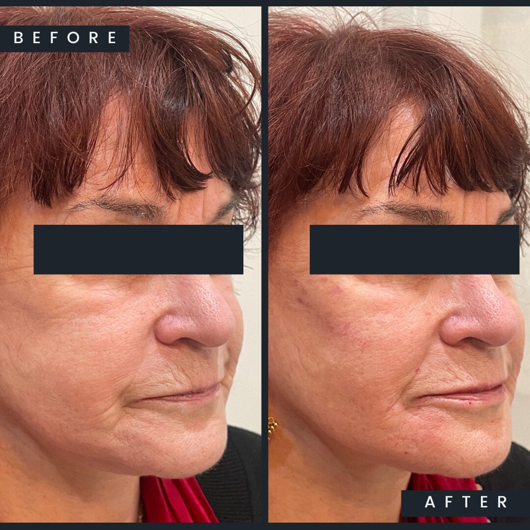 Spot the differences between these two pictures 🔎

Let's walk through the treatments included that produced these gorgeous results:
🌟 #Radiesse for the cheeks - this smoothed out and plumped up the cheeks
🌟1 syringe of a blended RHA3 for the mouth