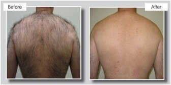 Hair Removal Sheffield — The Laser Clinic