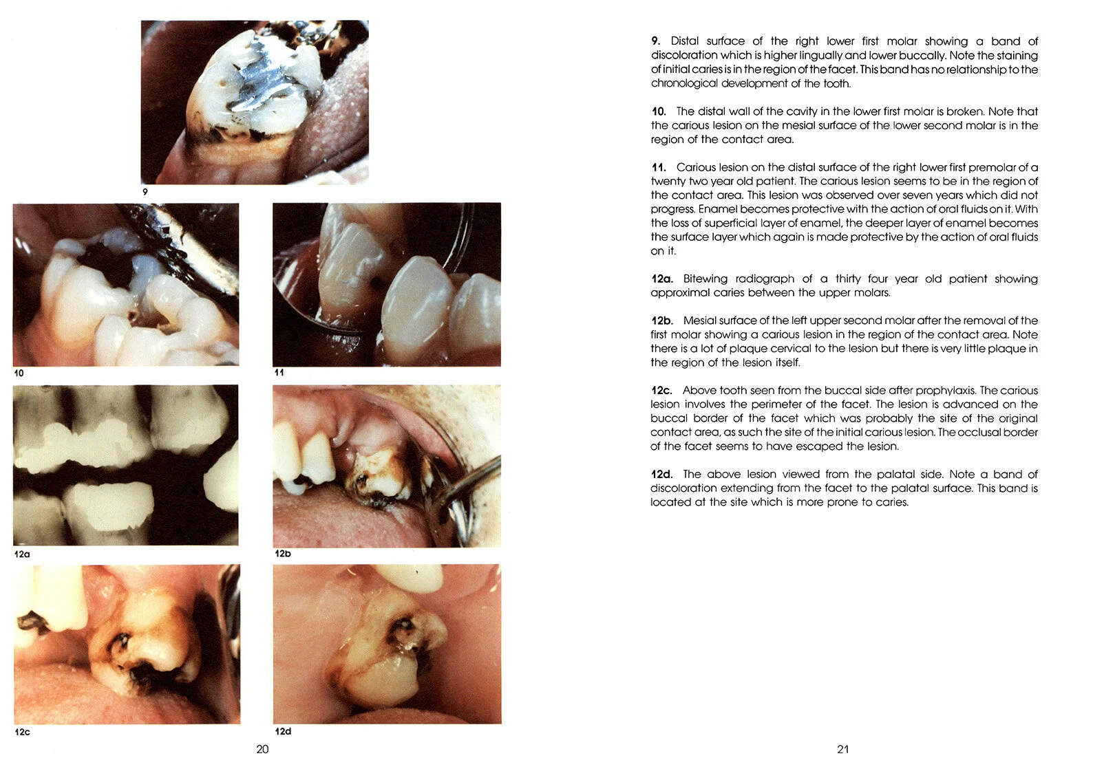 Colour_Atlas_of_a_New_Concept_of_Enamel_Caries-High_Resolution_Page_030.jpg