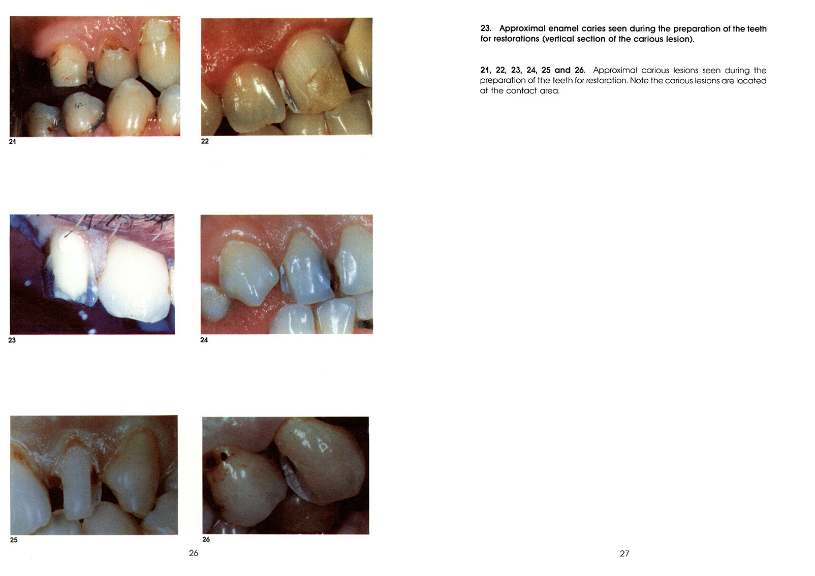 Colour_Atlas_of_a_New_Concept_of_Enamel_Caries-High_Resolution_Page_036.jpg