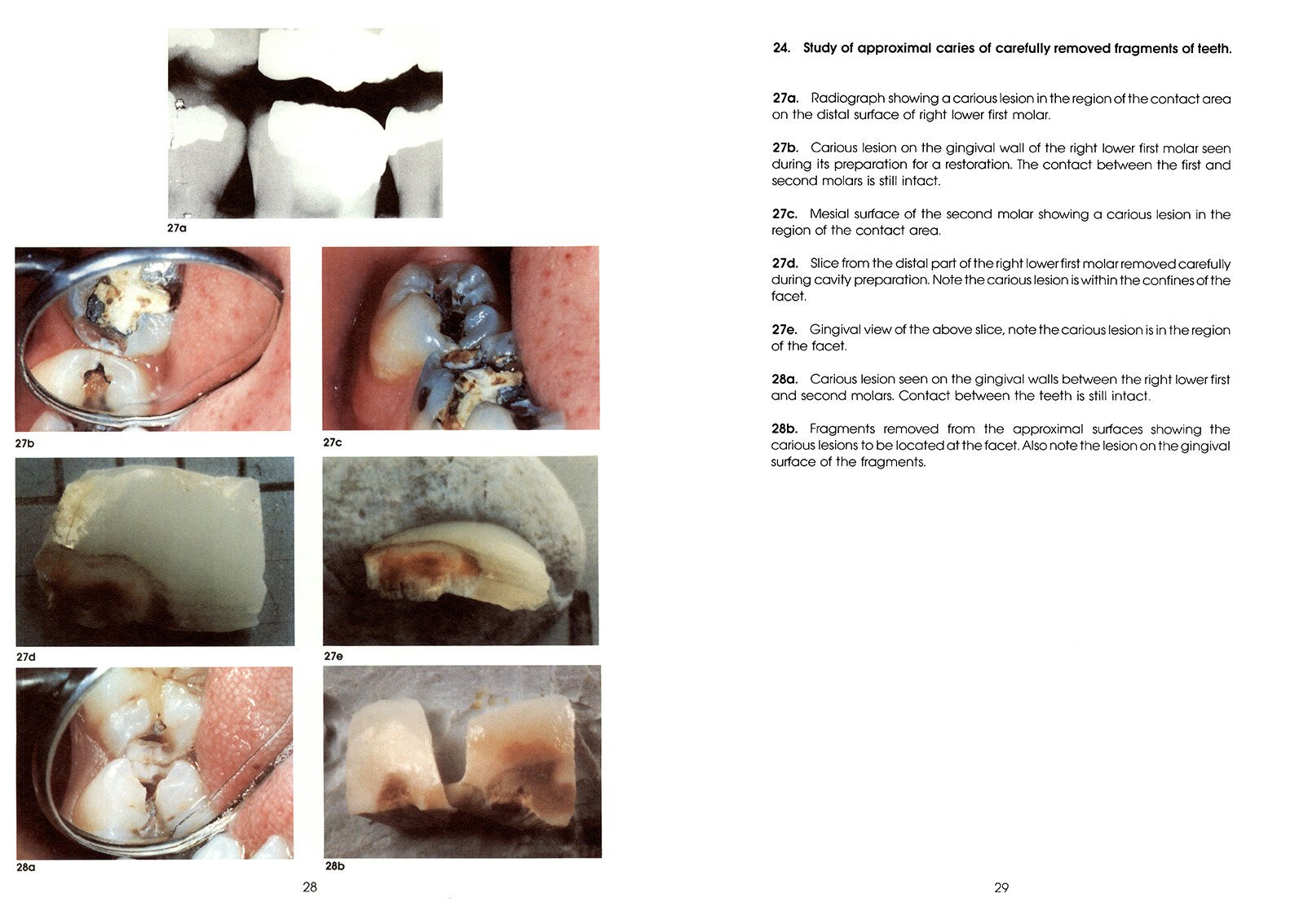 Colour_Atlas_of_a_New_Concept_of_Enamel_Caries-High_Resolution_Page_038.jpg