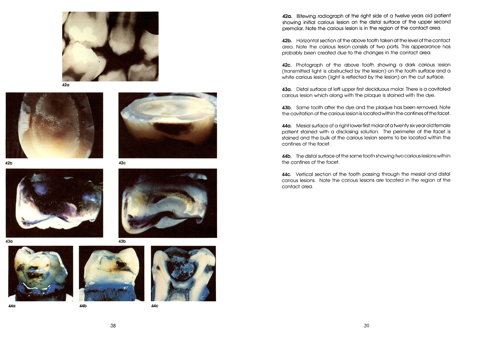 Colour_Atlas_of_a_New_Concept_of_Enamel_Caries-High_Resolution_Page_048.jpg