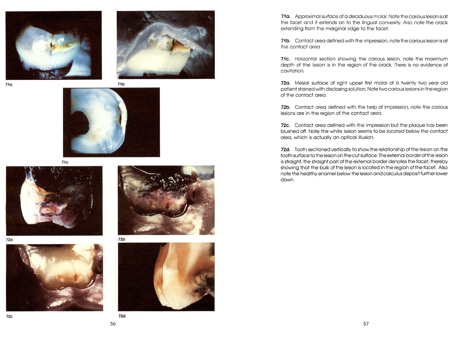 Colour_Atlas_of_a_New_Concept_of_Enamel_Caries-High_Resolution_Page_066.jpg