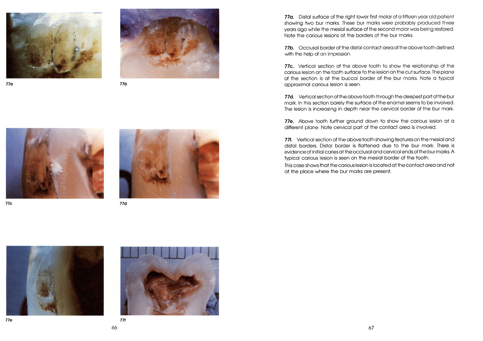 Colour_Atlas_of_a_New_Concept_of_Enamel_Caries-High_Resolution_Page_076.jpg