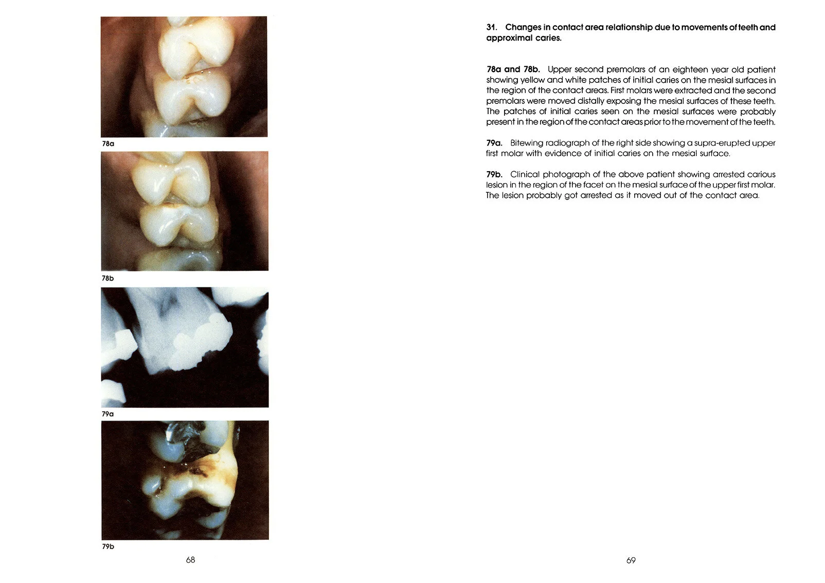 Colour_Atlas_of_a_New_Concept_of_Enamel_Caries-High_Resolution_Page_078.jpg