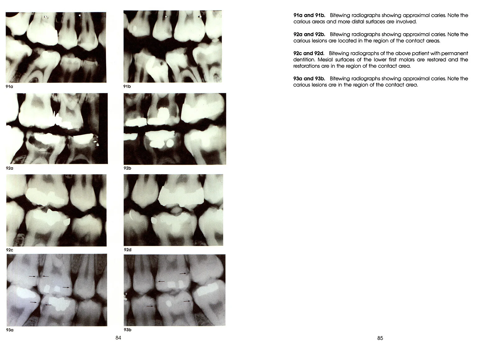 Colour_Atlas_of_a_New_Concept_of_Enamel_Caries-High_Resolution_Page_094.jpg