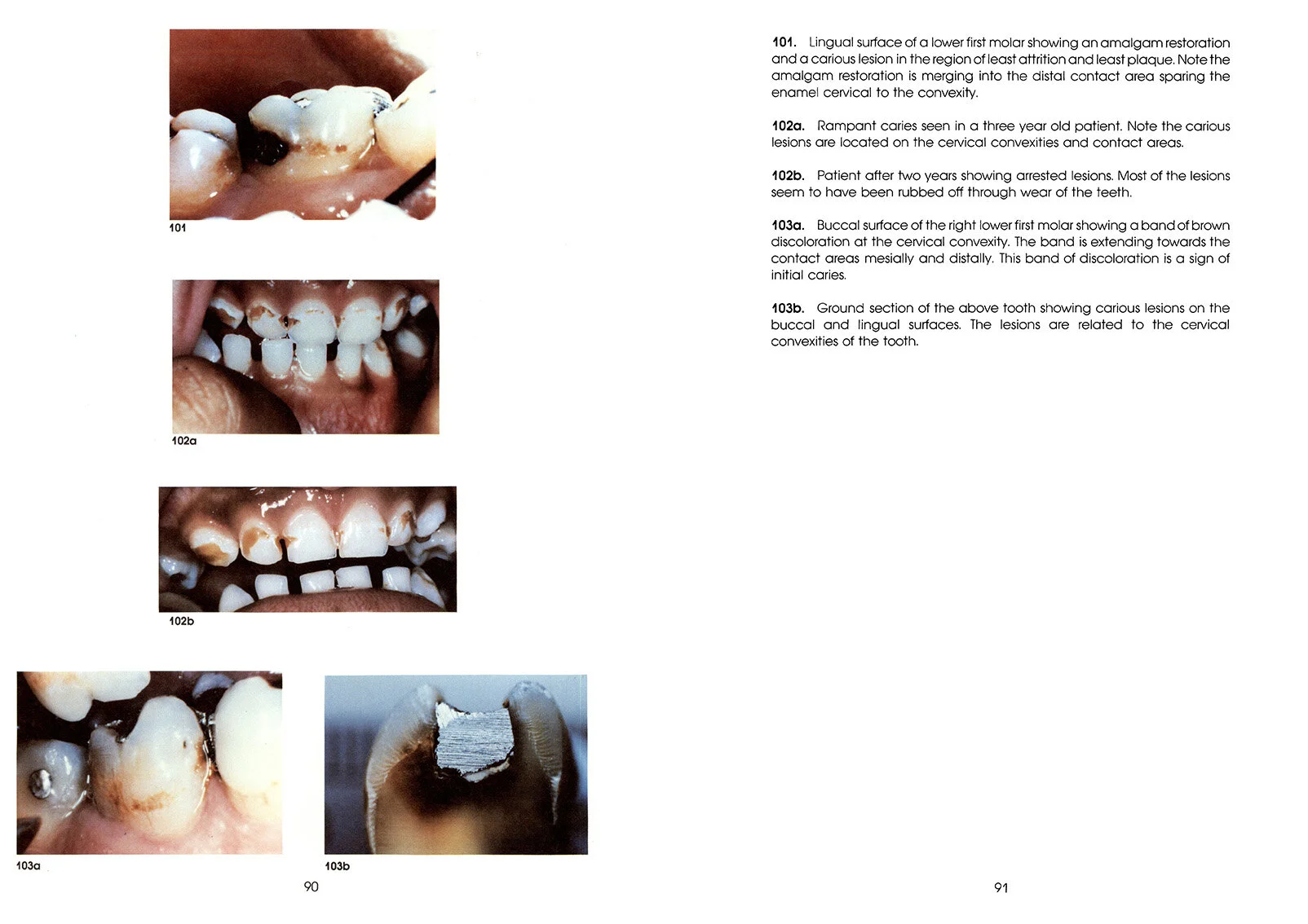 Colour_Atlas_of_a_New_Concept_of_Enamel_Caries-High_Resolution_Page_100.jpg