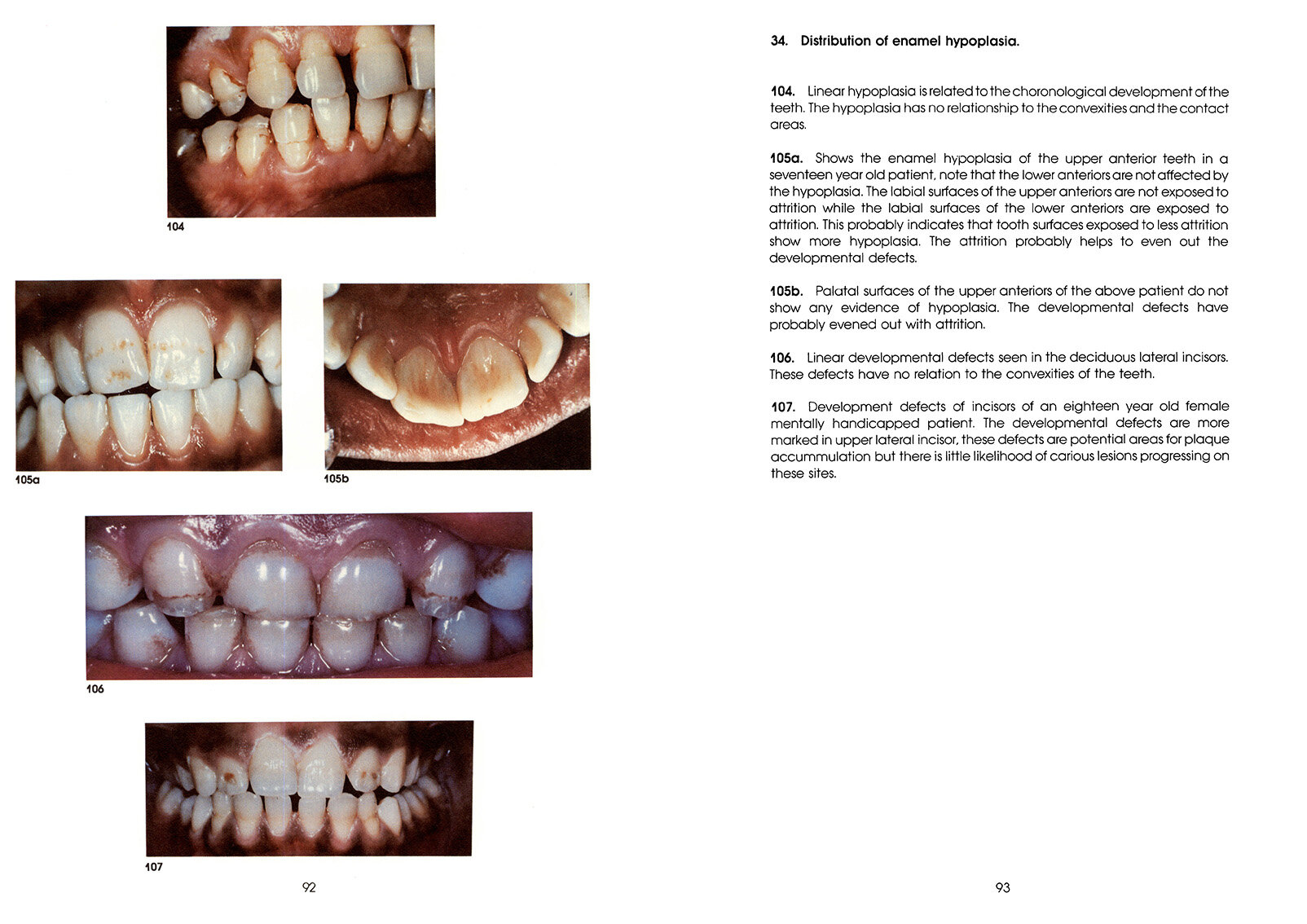 Colour_Atlas_of_a_New_Concept_of_Enamel_Caries-High_Resolution_Page_102.jpg