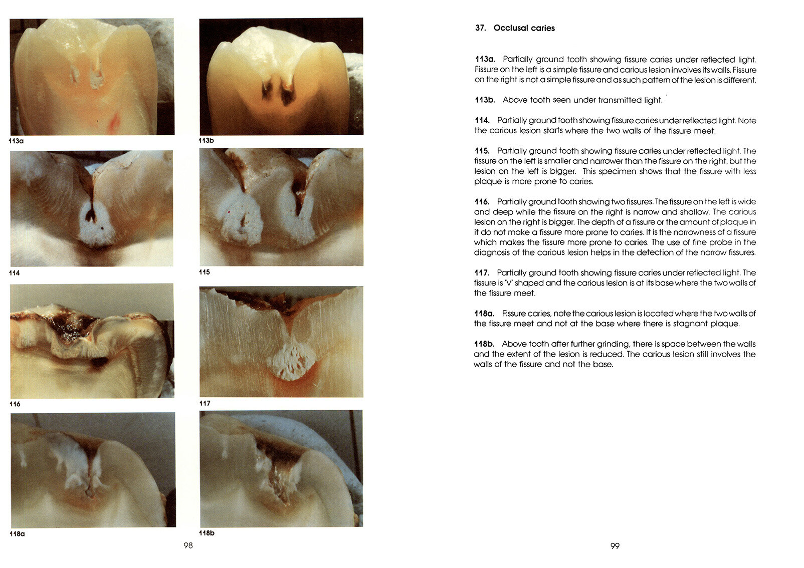 Colour_Atlas_of_a_New_Concept_of_Enamel_Caries-High_Resolution_Page_108.jpg