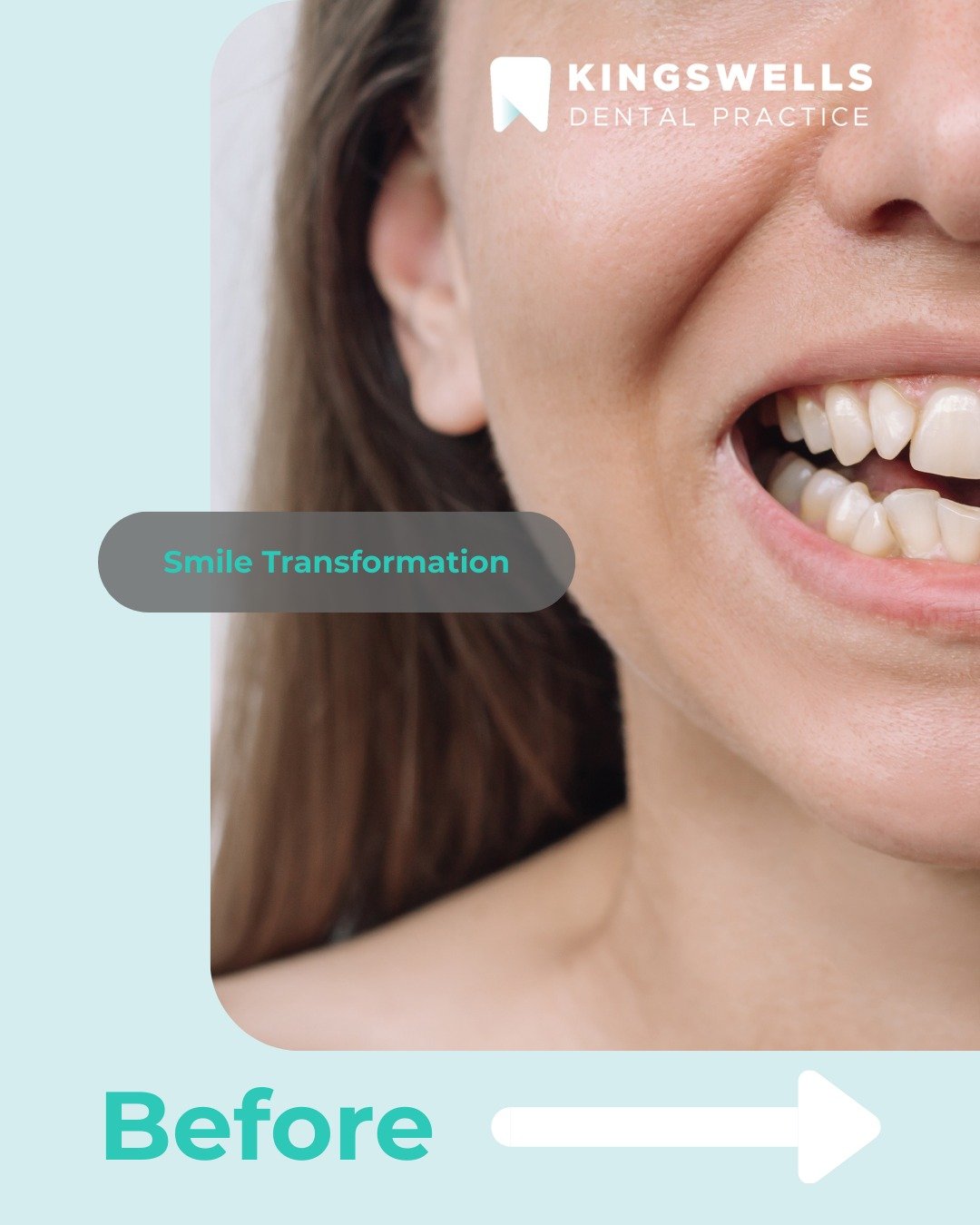 Before ➡️ After 🦷✨
A subtle transformation that made a big difference to confidence.

Book a consultation via the link in our bio.