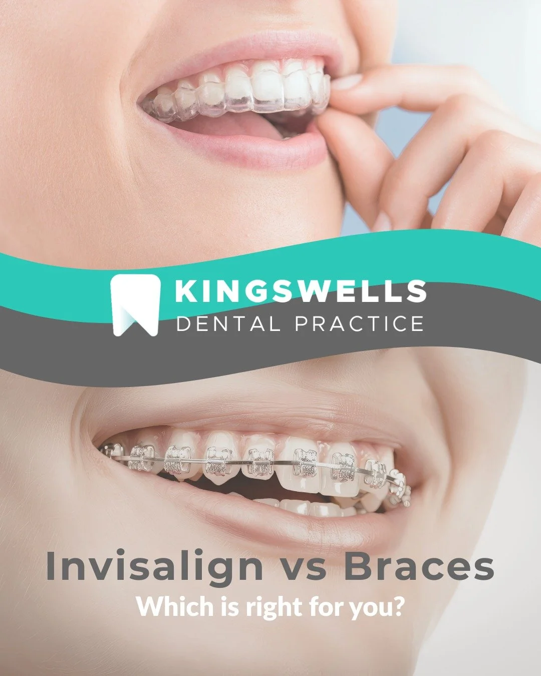 Thinking about straightening your teeth? 🦷✨
Invisalign&reg; offers a clear, comfortable, and flexible alternative to traditional braces, with natural-looking results.

Not sure which option is right for you?
Ask our team about Invisalign&reg; via th