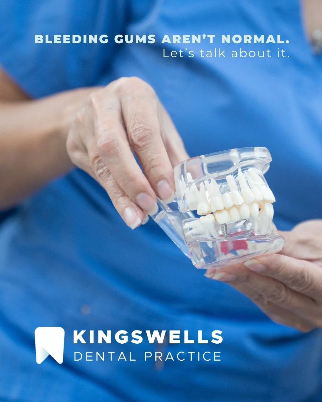 If your gums bleed when you brush or floss, it&rsquo;s not something to ignore.

Bleeding gums are often a sign of inflammation or early gum disease and the good news is, it&rsquo;s very treatable when caught early.

Our hygienist team at Kingswells 