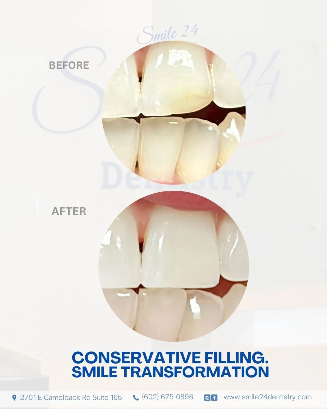 Conservative Filling. Front Teeth.Smile 24 Dentistry in Phoenix ScottsdaleAz