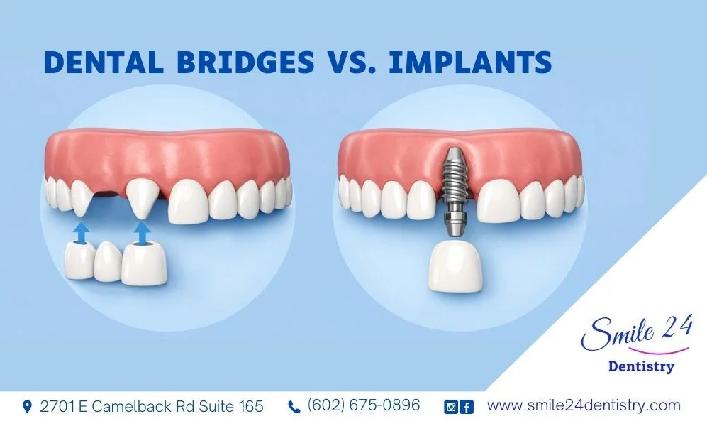 Dental bridges vs. implants: what’s better for a missing tooth?