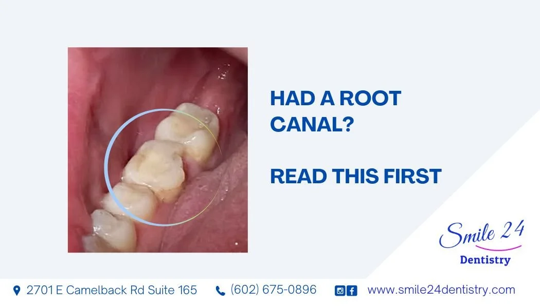 Do You Need a Crown After a Root Canal? What Happens If You Skip It
