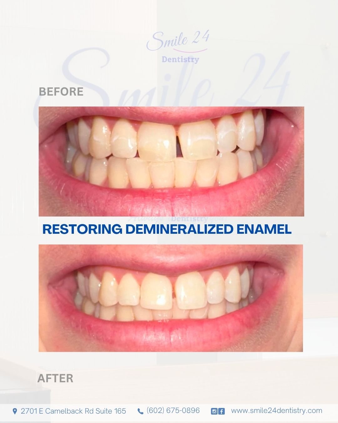 White Spots on Teeth After Braces: A Conservative Cosmetic Solution