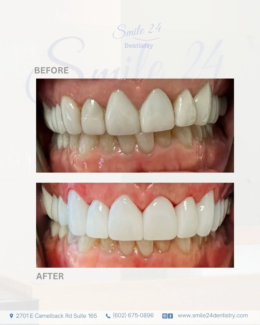 Smile Transformation Before and After by Smile 24 Dentistry in Phoenix, Az, Biltmore area