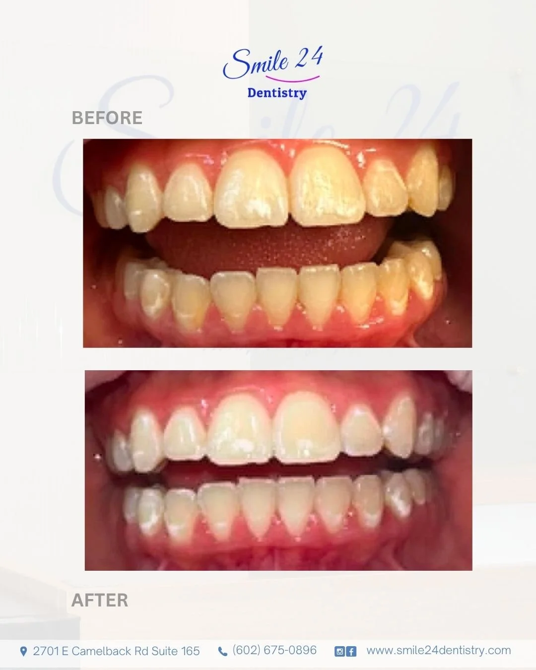 Professional In-Office  Teeth Whiteningby Smile 24 Dentistry in Phoenix, Az, Biltmore area