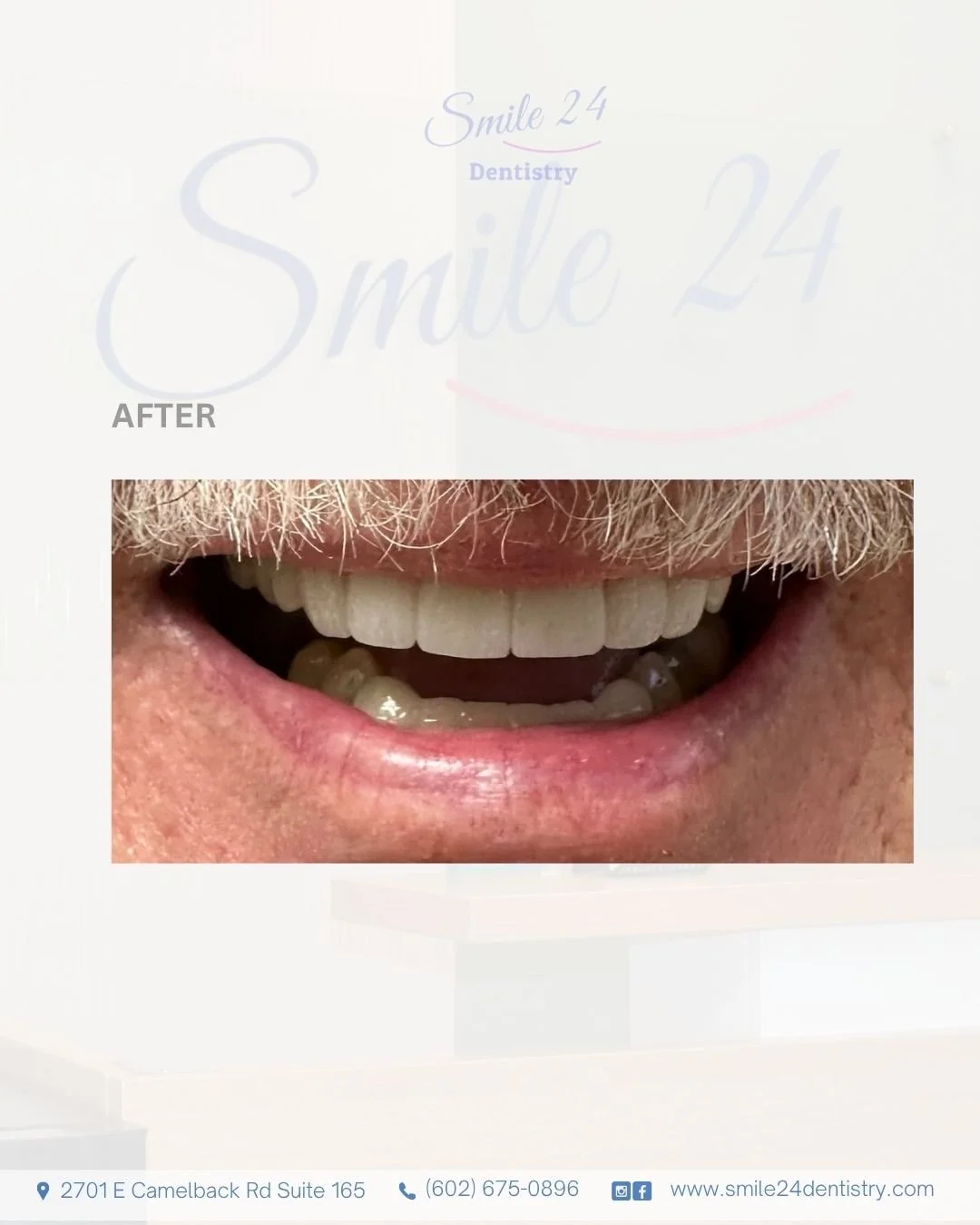 Smile Transformation Before and After by Smile 24 Dentistry in Phoenix, Az, Biltmore area