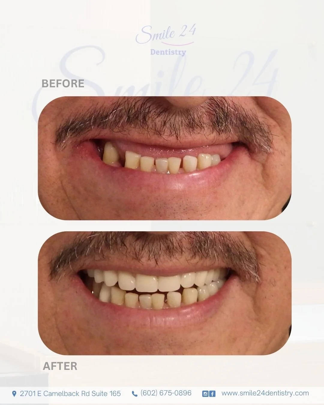 Smile Transformation Before and After by Smile 24 Dentistry in Phoenix, Az, Biltmore area