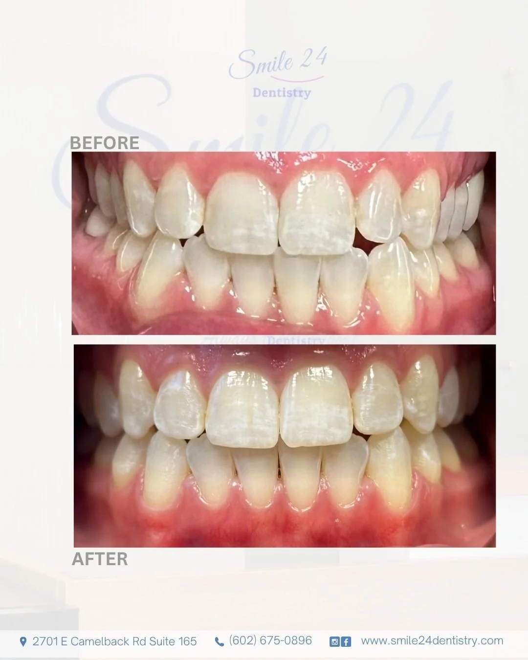 Teeth straightening with clear aligners in Phoenix Scottsdale Paradise Valley
